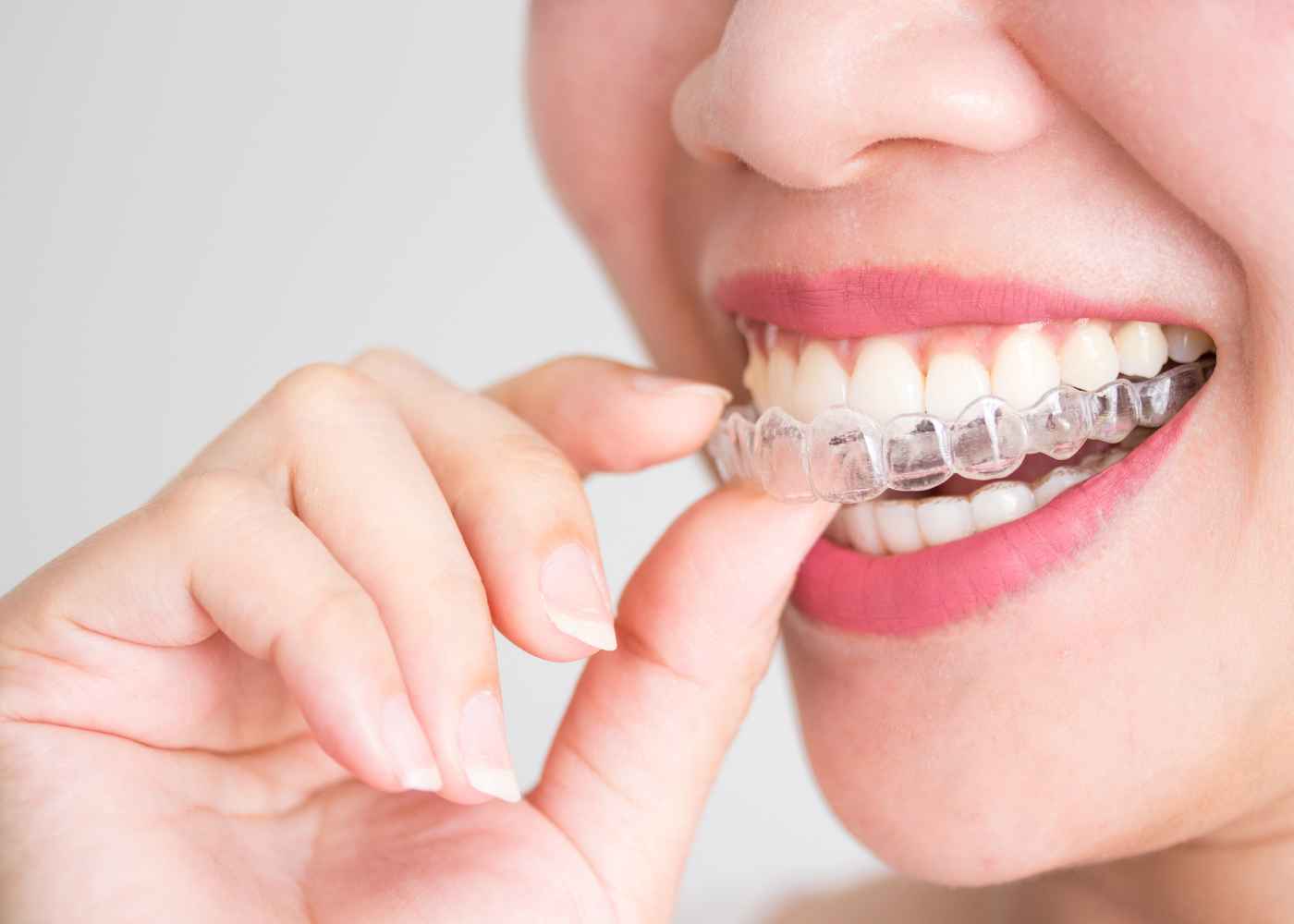 Discover the Smile Revolution with Invisible Braces