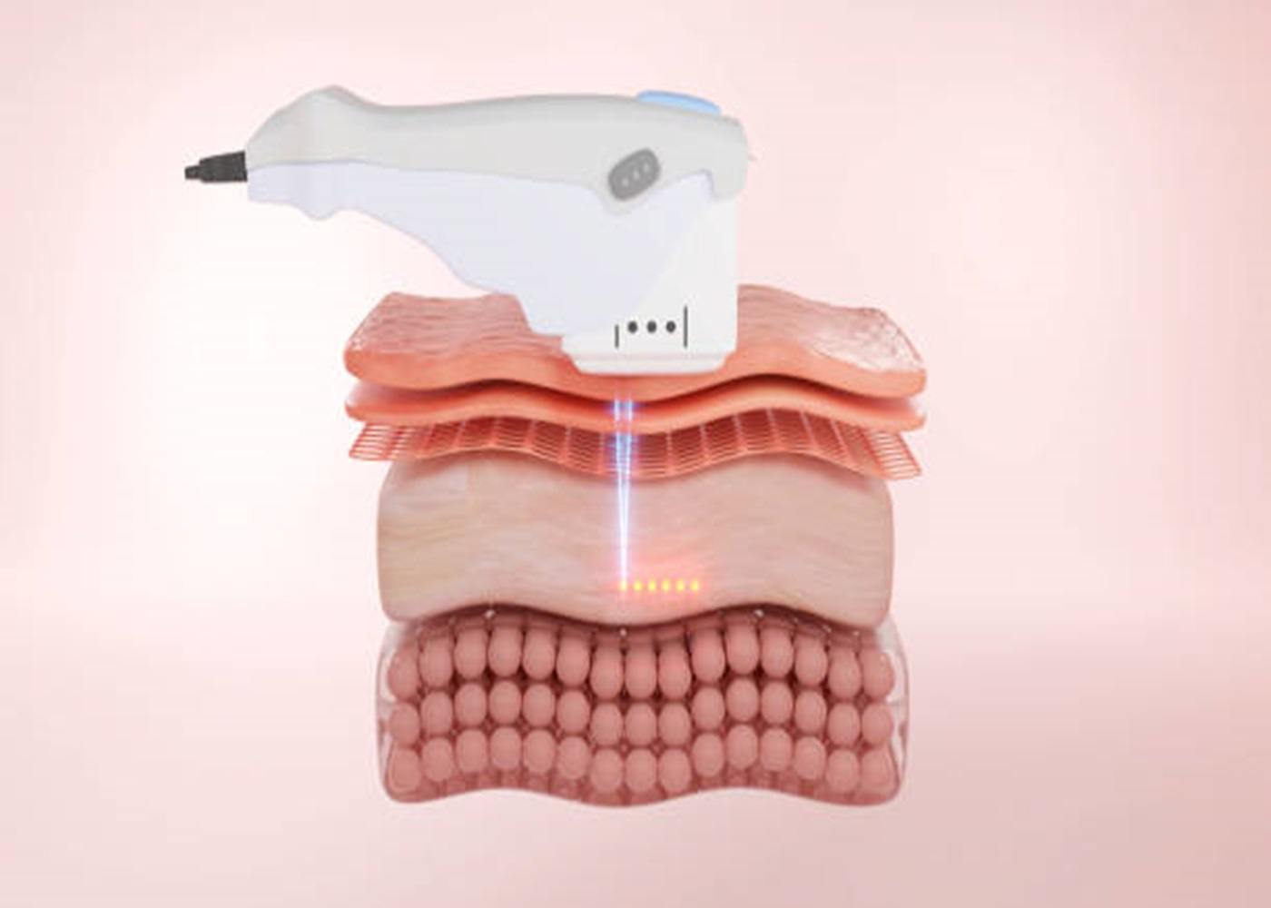 7D HIFU: A definitive Enemy of Maturing Treatment
