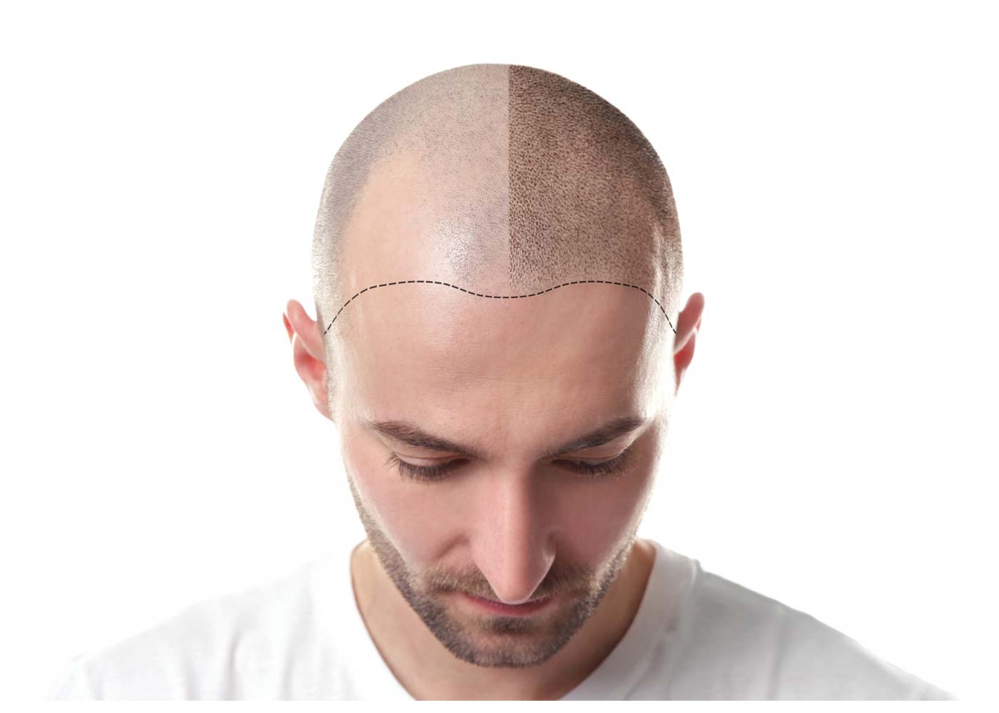 A Guide to Fixing Scalp Micropigmentation Damage
