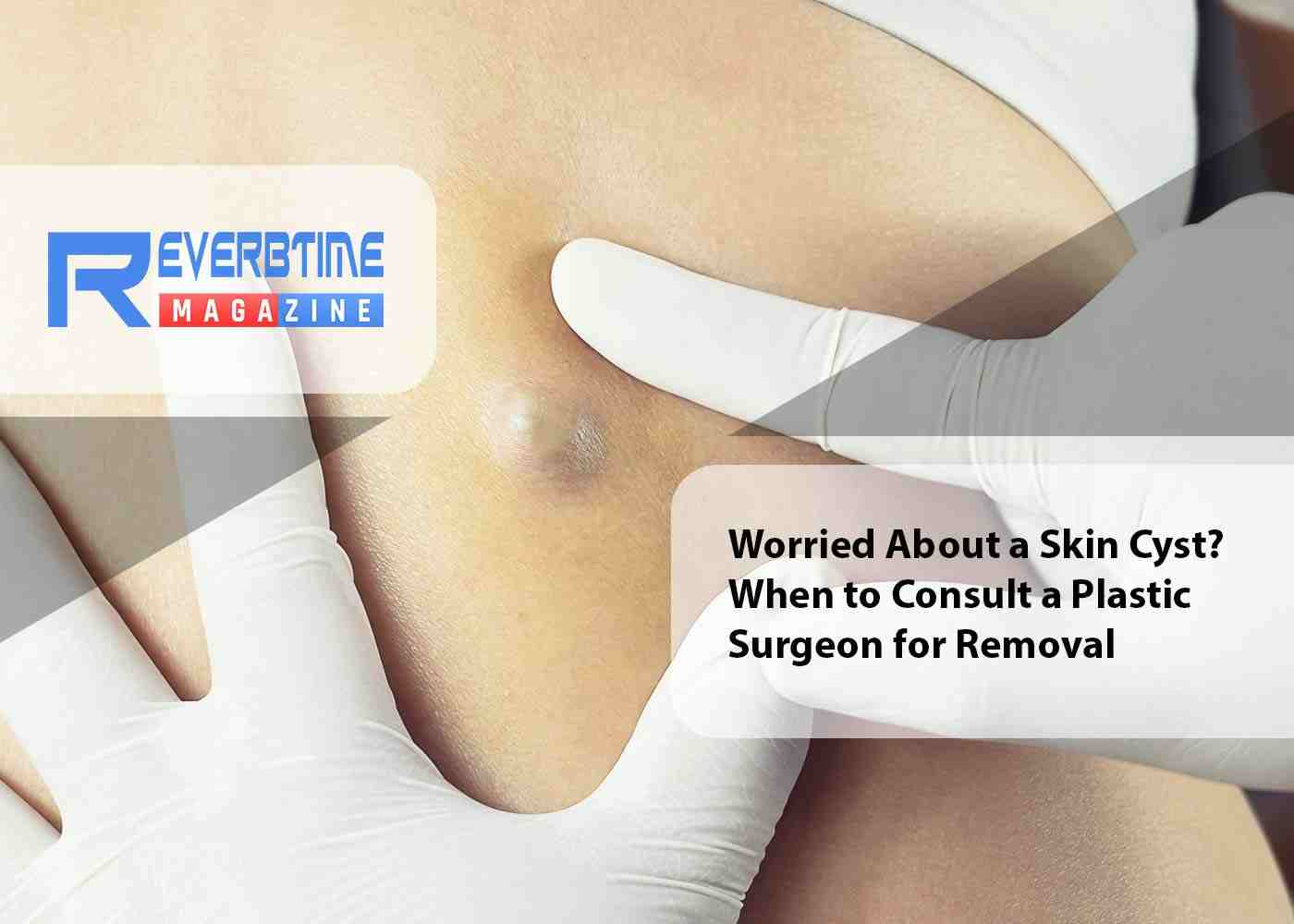 Worried About a Skin Cyst? When to Consult a Plastic Surgeon for Removal
