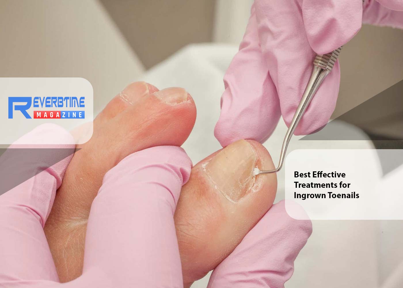 Best Effective Treatments for Ingrown Toenails