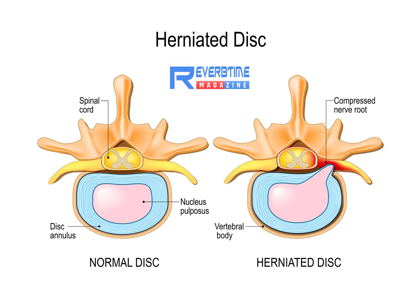Best Exercises and Treatments for a Herniated Disc