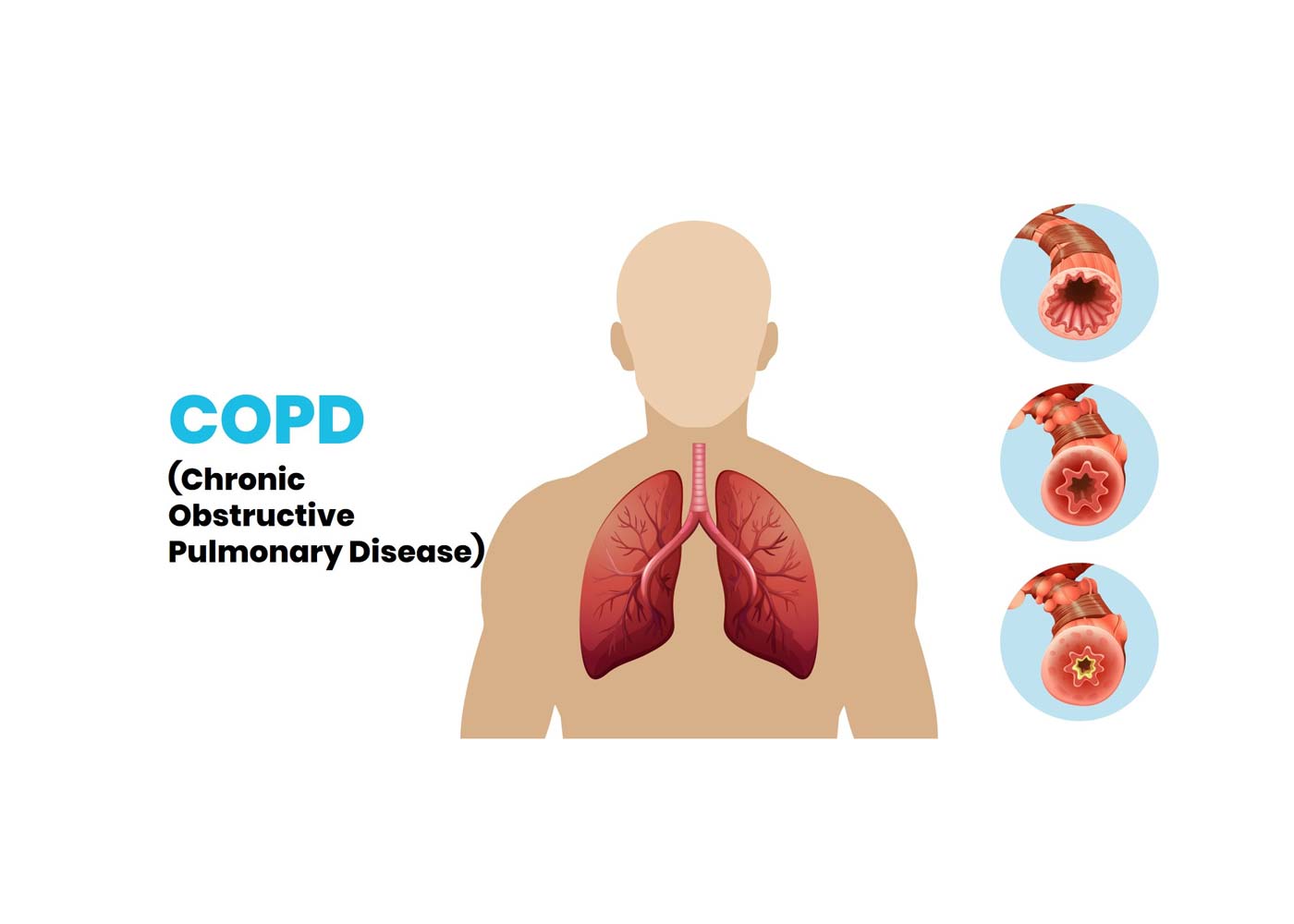 Early Signs of Chronic Obstructive Pulmonary Disease (COPD)
