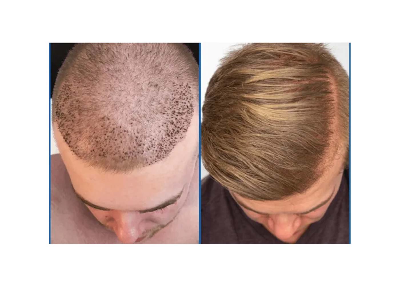 Facts about Young Men Hair Transplant