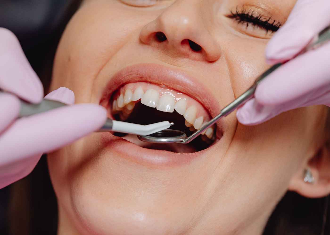 How Hybridge Dental Implants Transform Smiles and Function