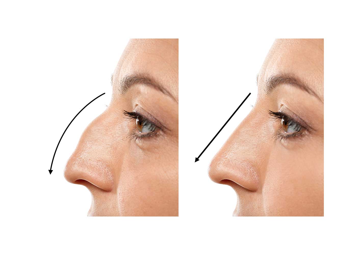 The Countdown to a New Nose: How Long Does Rhinoplasty Take?