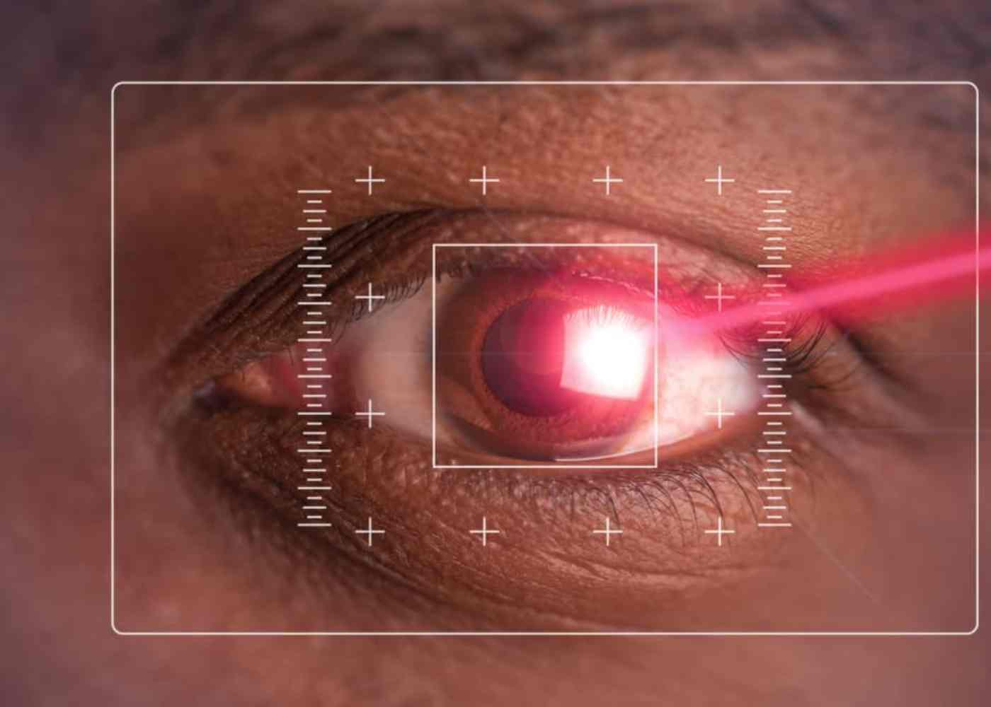How Refractive Surgery Revolutionized Eye Care in Nigeria
