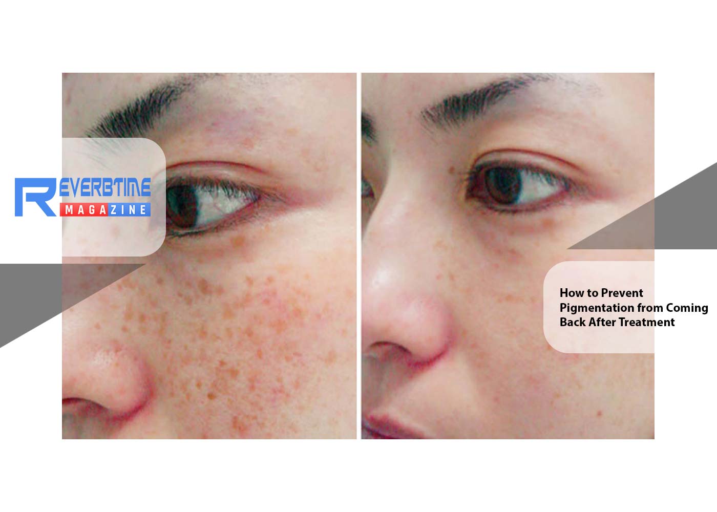How to Prevent Pigmentation from Coming Back After Treatment