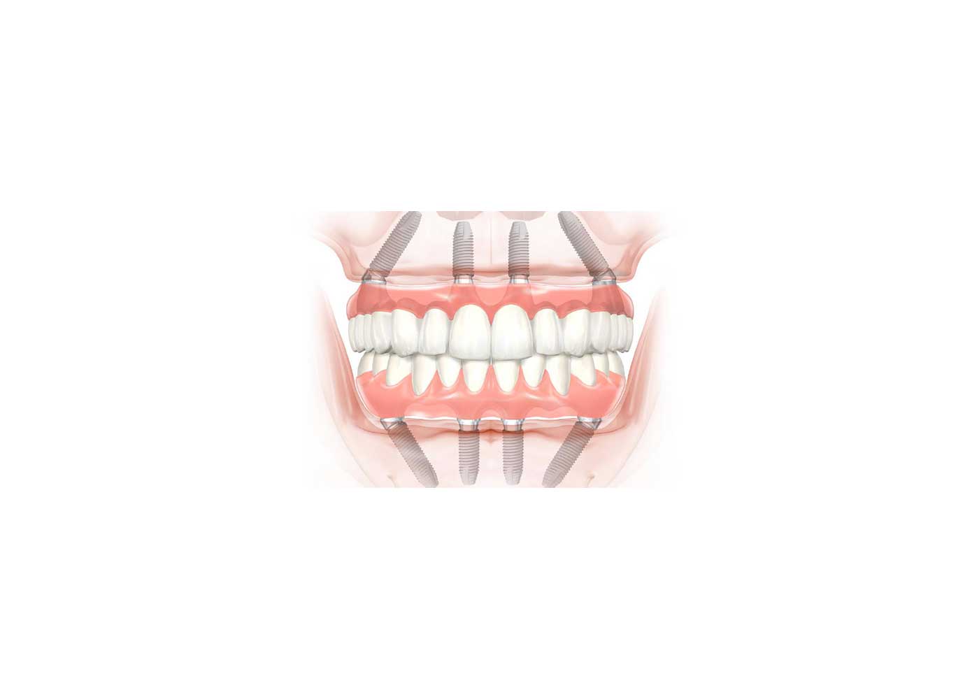 Revolutionizing Dental Care: Exploring Dental Bonding and All-on-Four Implant Techniques