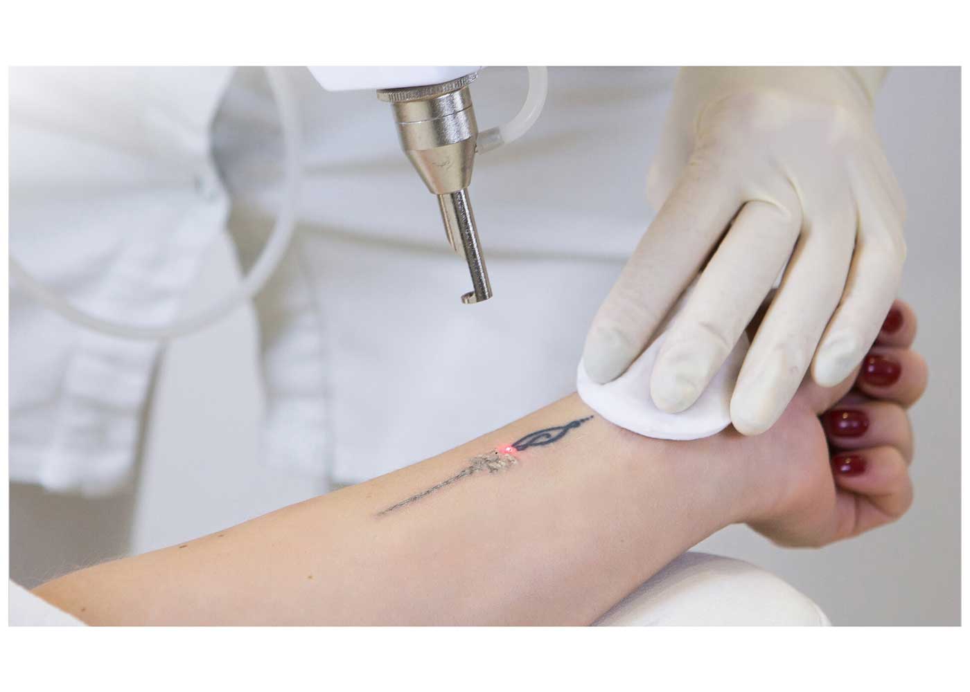 Tattoo Removal - Your Path to a Regret-Free Future