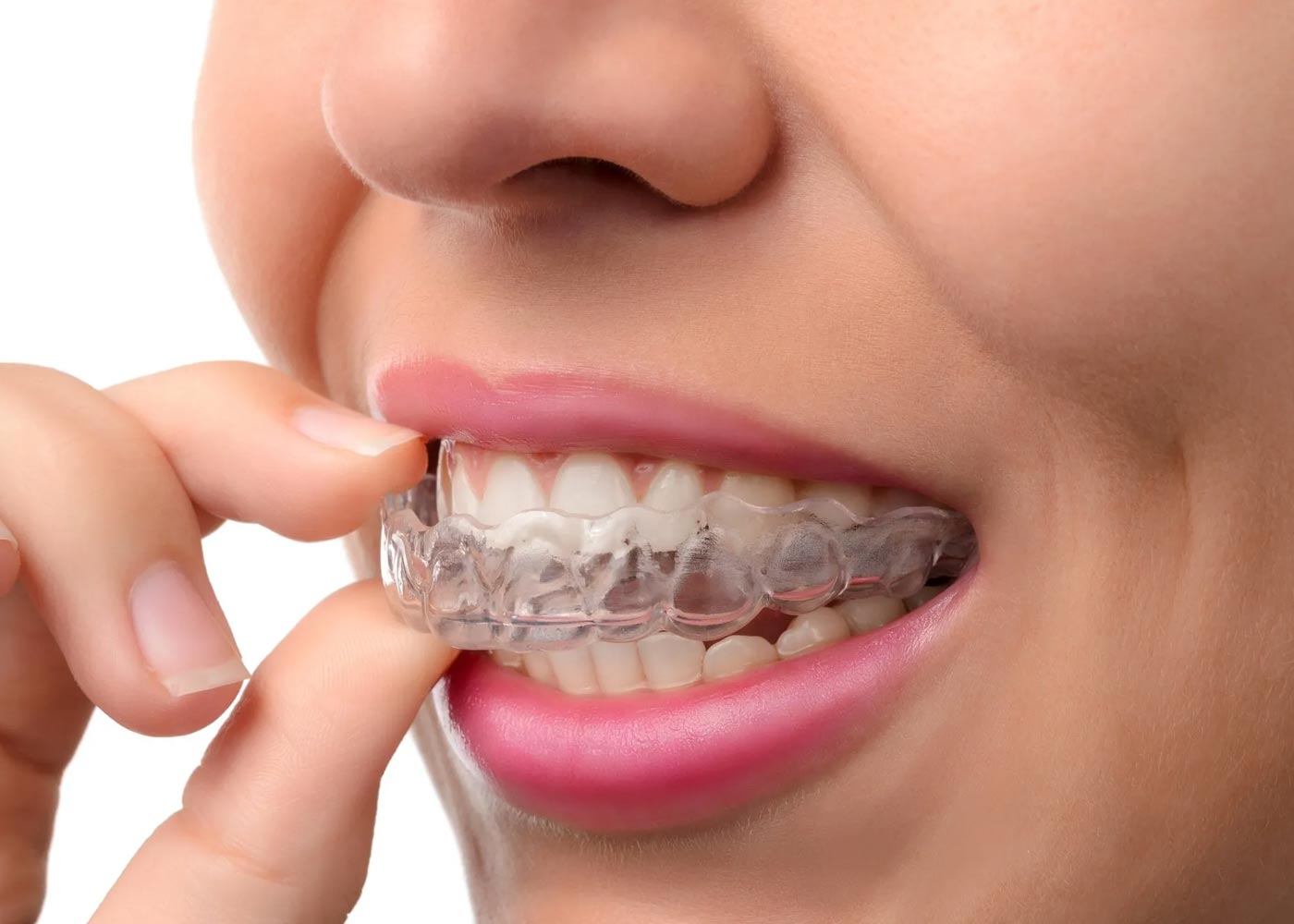 The Comprehensive Guide to Invisalign: What Every Patient Should Know