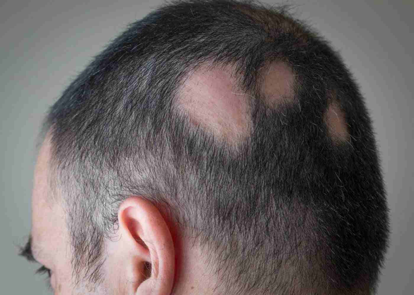 Top 5 Causes of Hair Loss in Men
