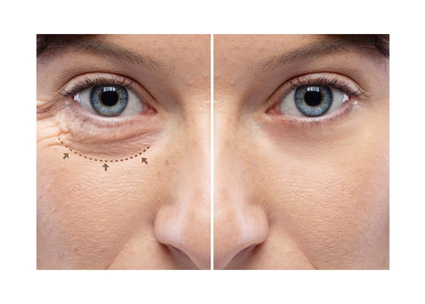 Enhancing Your Natural Beauty: Exploring the Transformative Effects of Eyebrow and Eyelid Lift Surgery