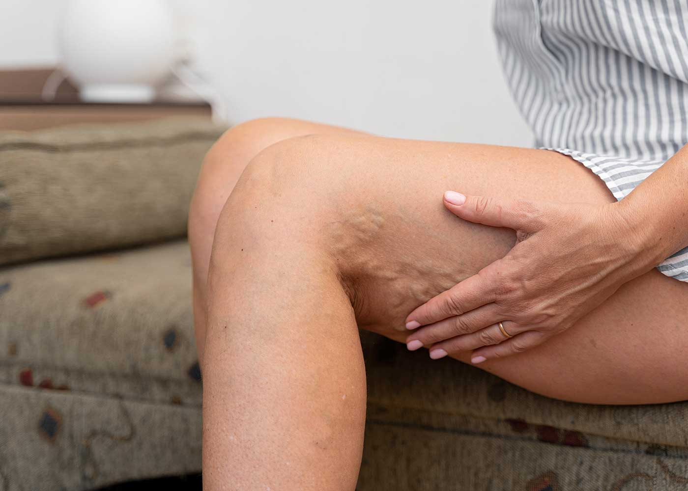 Unveiling the Mystery behind Bulging Veins: A Comprehensive Guide to Varicose Veins