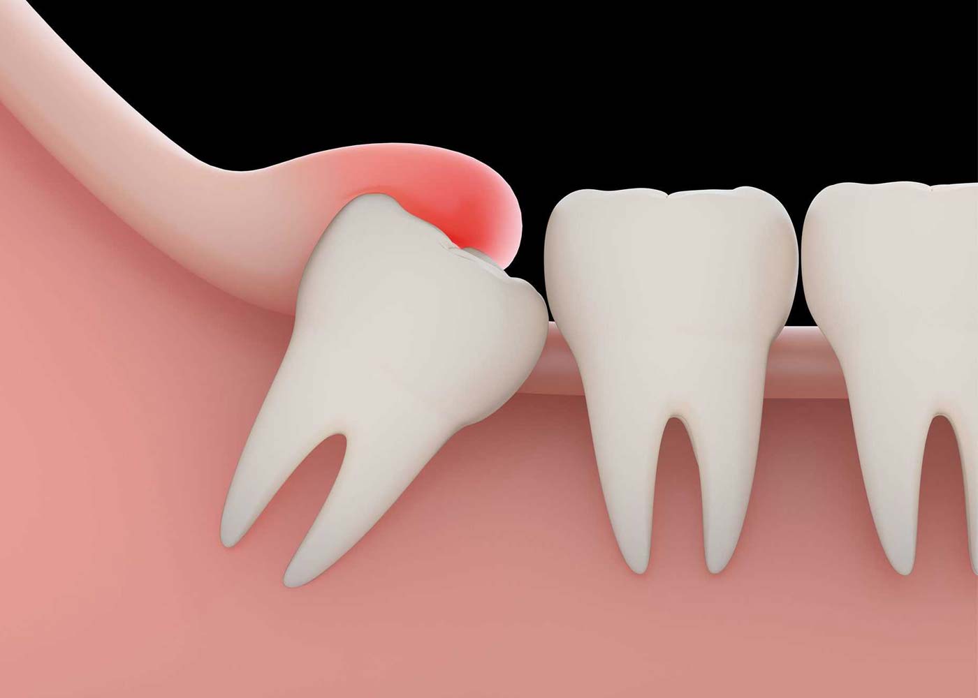 Unveiling the Mystery of Wisdom Teeth Extraction