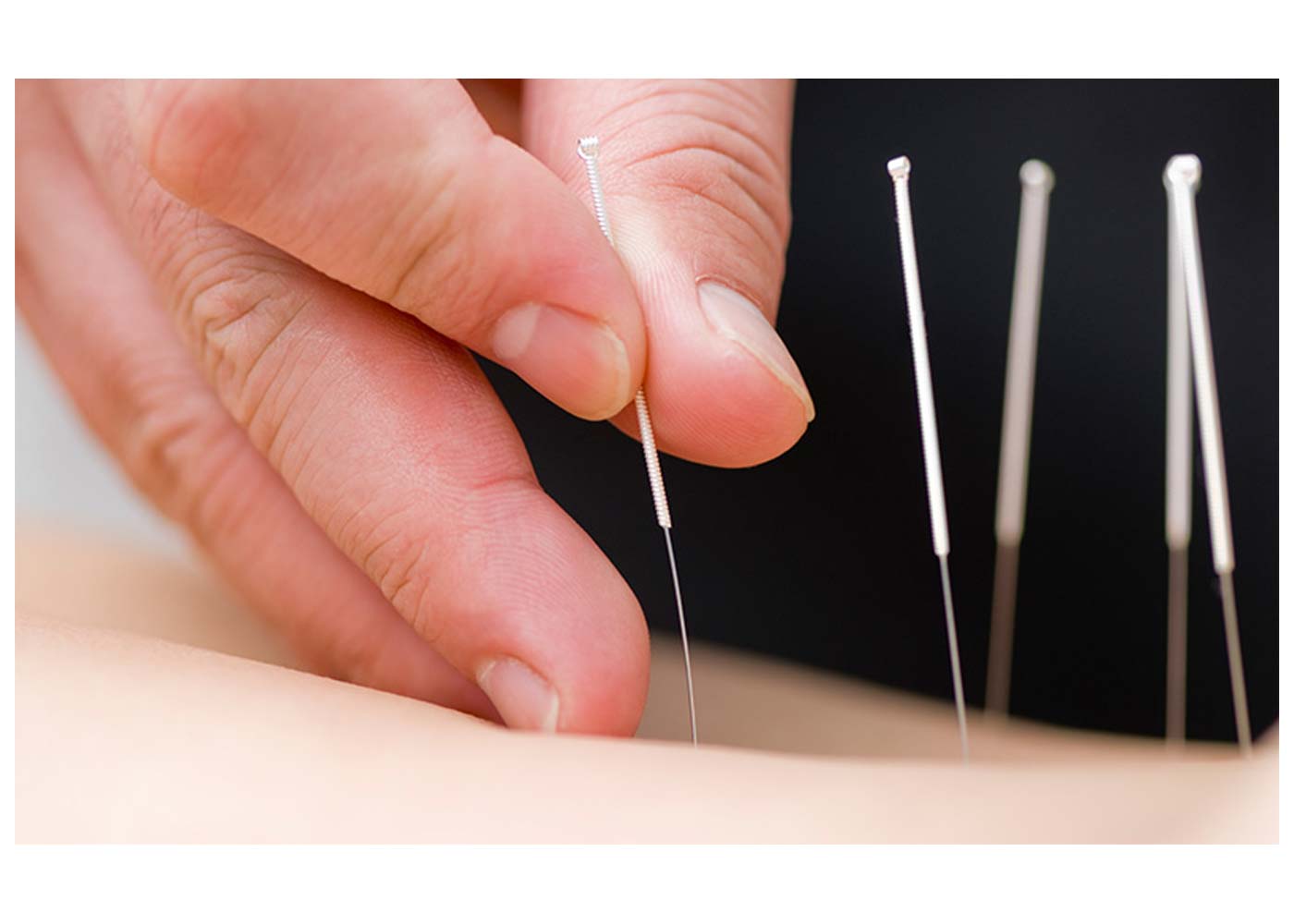 Why IMS Treatment Is a Game-Changer for Chronic Pain Sufferers