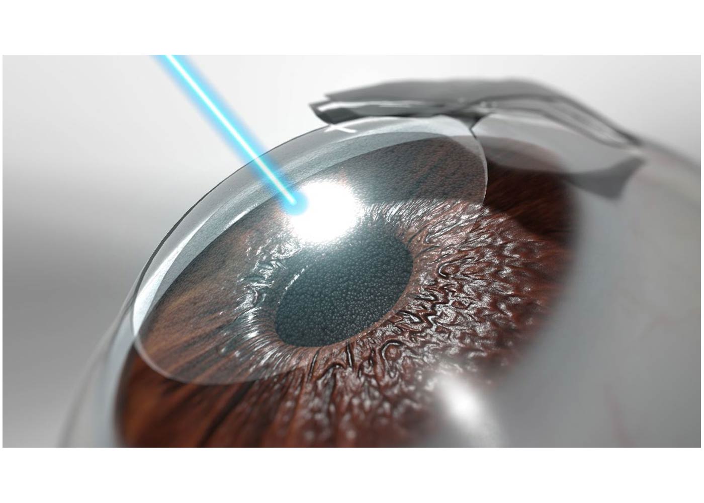 Why winter is the Best Time for LASIK Surgery